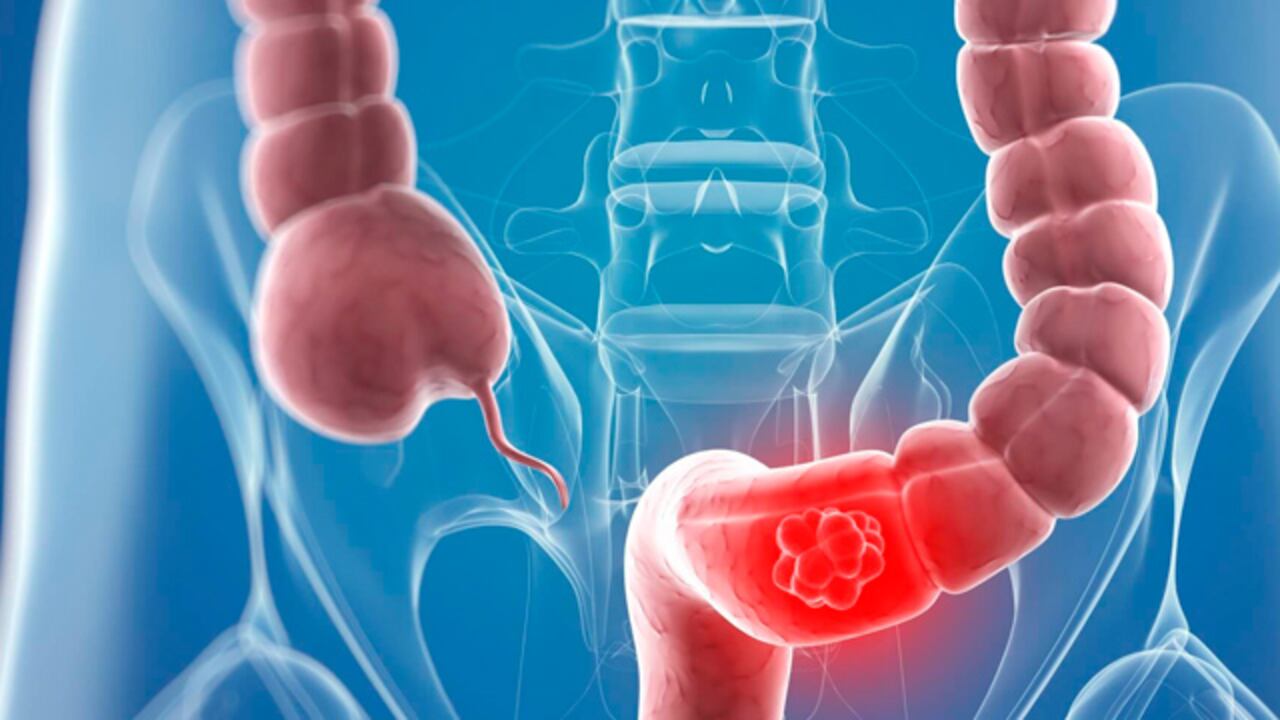 El diagnóstico temprano del cáncer de colon y recto abre la posibilidad de tener más opciones de tratamiento, con un mejor pronóstico y una recuperación más rápida. Reconocer síntomas y hacer los exámenes preventivos podría salvar vidas.