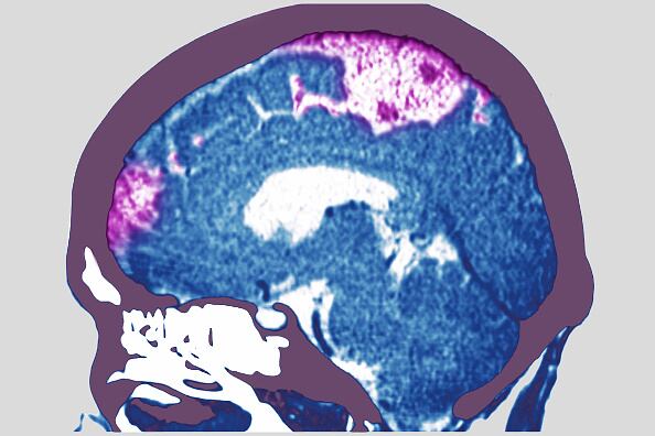 El infarto o derrame cerebral es ocasionada por la interrupción de la irrigación sanguínea o cuando un vaso sanguíneo se rompe, que puede derivar en problemas para caminar, hablar y entender, además de parálisis o entumecimiento del rostro, los brazos o las piernas. (Photo by: BSIP/Universal Images Group via Getty Images)