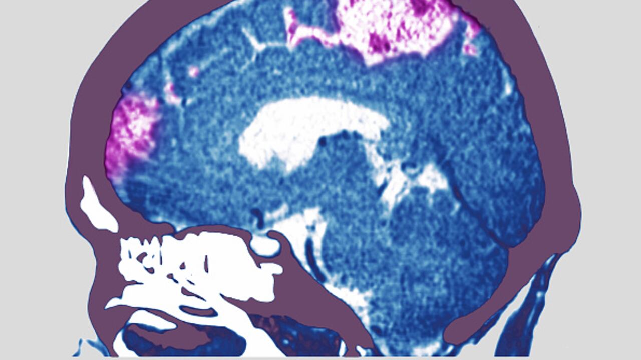 El infarto o derrame cerebral es ocasionada por la interrupción de la irrigación sanguínea o cuando un vaso sanguíneo se rompe, que puede derivar en problemas para caminar, hablar y entender, además de parálisis o entumecimiento del rostro, los brazos o las piernas. (Photo by: BSIP/Universal Images Group via Getty Images)