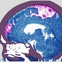 El infarto o derrame cerebral es ocasionada por la interrupción de la irrigación sanguínea o cuando un vaso sanguíneo se rompe, que puede derivar en problemas para caminar, hablar y entender, además de parálisis o entumecimiento del rostro, los brazos o las piernas. (Photo by: BSIP/Universal Images Group via Getty Images)