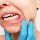 Muchas personas sufren inflamación en las encías, que se origina esencialmente por la acumulación de placa bacteriana, debido a que no se ha realizado una correcta higiene oral diaria.