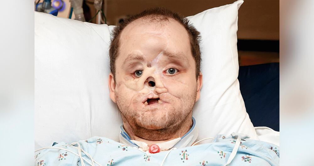 Derek recibió la mayor parte del rostro de un donante, incluyendo parte de los huesos de la frente, la nariz, las mandíbulas superior e inferior, los dientes, los pómulos, un párpado superior e inferior, la boca y toda la piel del rostro y cuello.