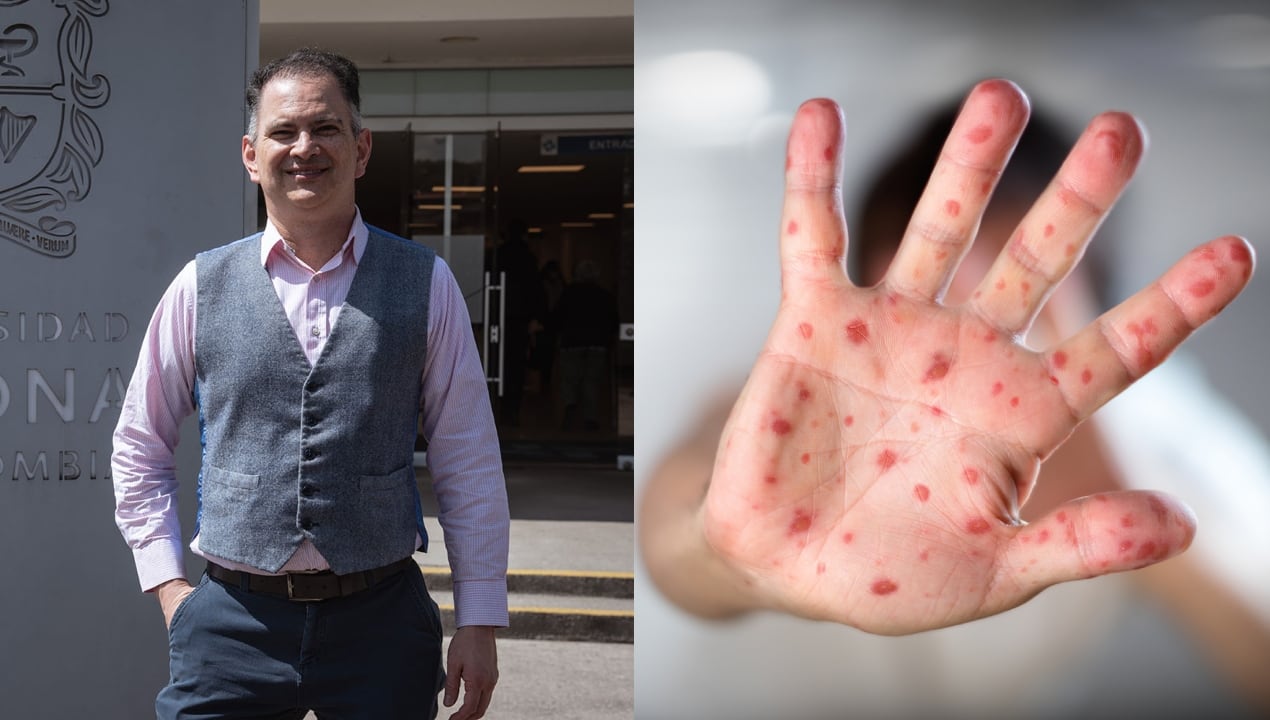 Canadá, México y Estados Unidos son los países que tienen mayor número de casos de sarampión en el mundo desde finales del 2024 y a la fecha. Entre esos tres países juntos son más de 10 000 casos.