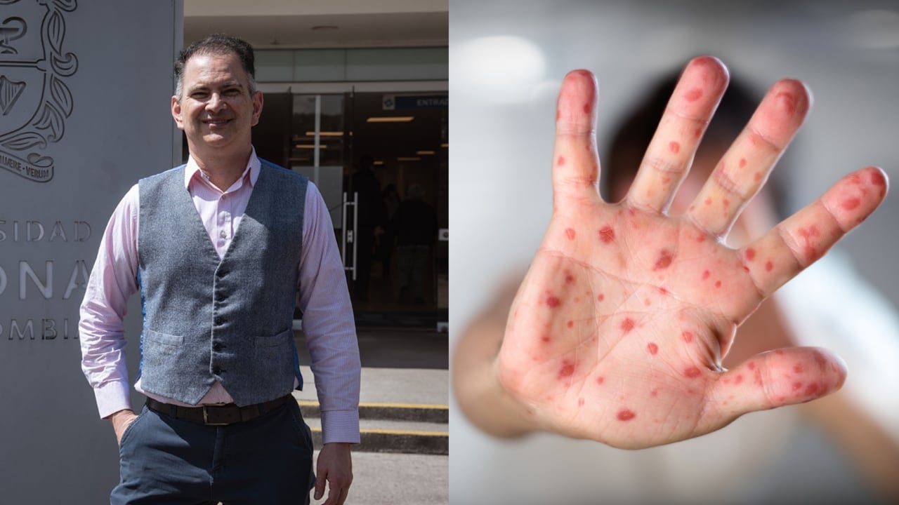 Canadá, México y Estados Unidos son los países que tienen el mayor número de casos de sarampión en el mundo desde finales de 2024 a la fecha.