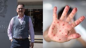 Canadá, México y Estados Unidos son los países que tienen mayor número de casos de sarampión en el mundo desde finales del 2024 y a la fecha. Entre esos tres países juntos son más de 10 000 casos.