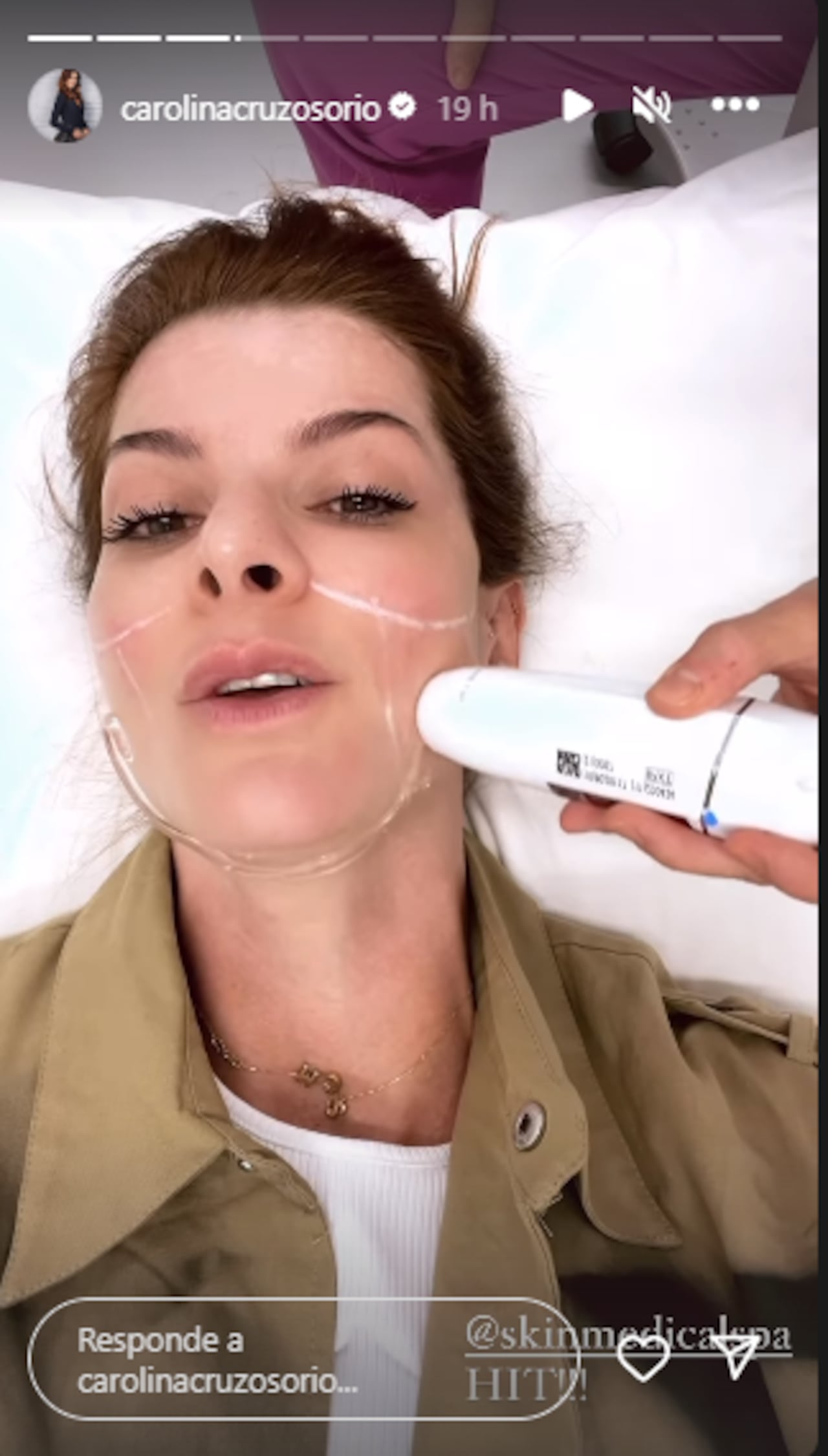 Carolina Cruz compartió el procedimiento estético al que se está sometiendo para la papada.