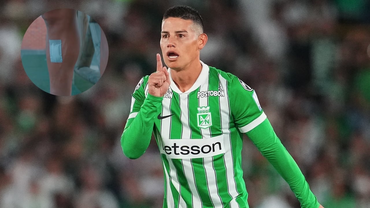 James Rodríguez y la herida que le quedó tras el partido. contra Inter de Bogotá.