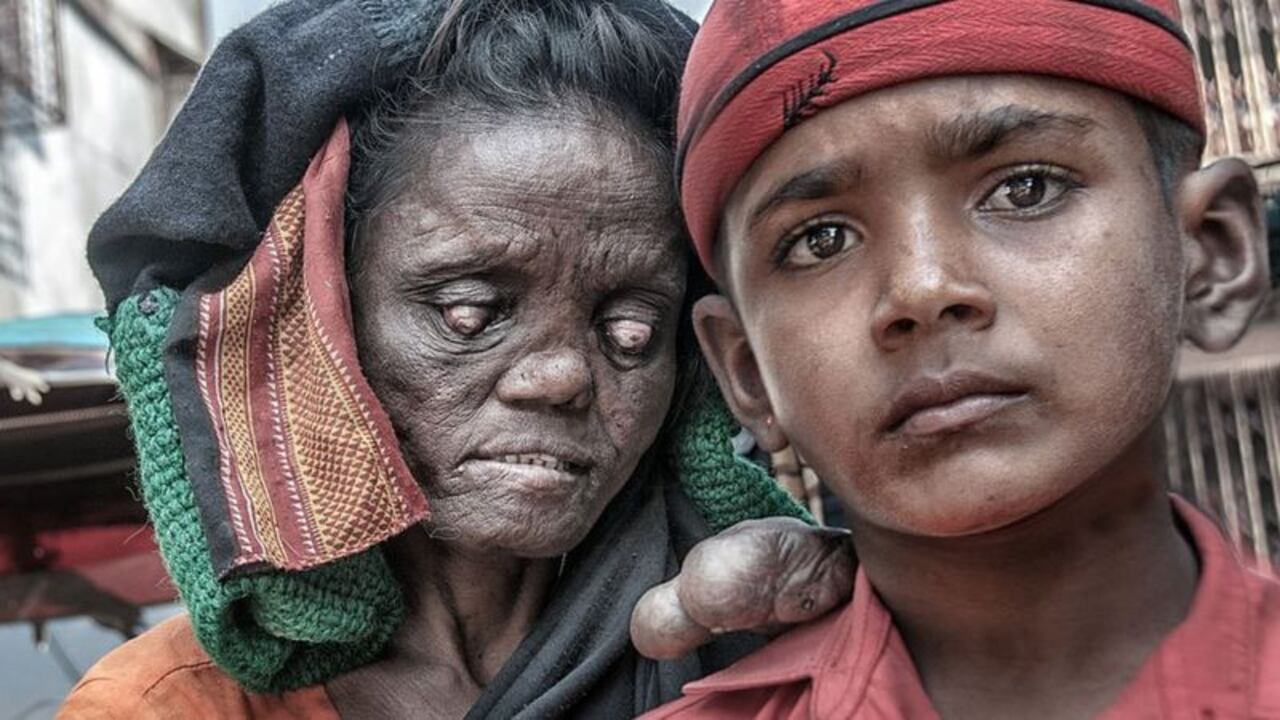 En qué países sigue habiendo lepra