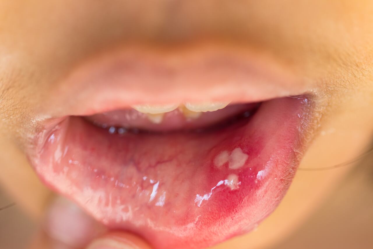 Úlcera bucal.
Mouth ulcer or canker sore or aphthous stomatitis or aphthous ulcer