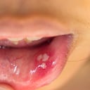 Afta o úlcera bucal