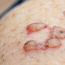 Verrugas, así se eliminan