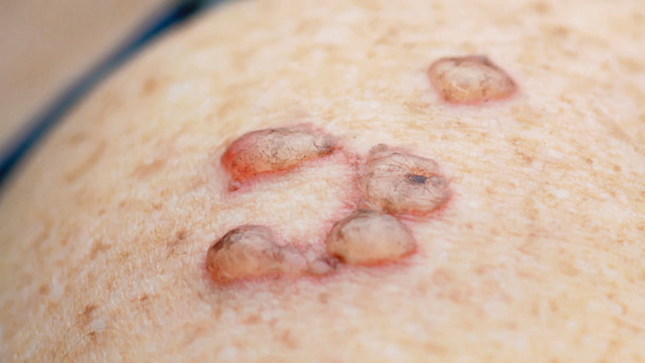 Cómo eliminar las verrugas que aparecen en la piel.