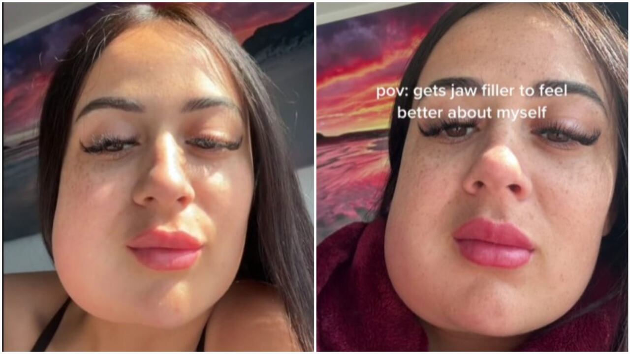 Tiktoker comentó que la inflamación siguió en un mismo punto hasta por casi 15 días en los que tuvo limitaciones para comer.