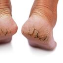 Es importante mantener los talones agrietados.