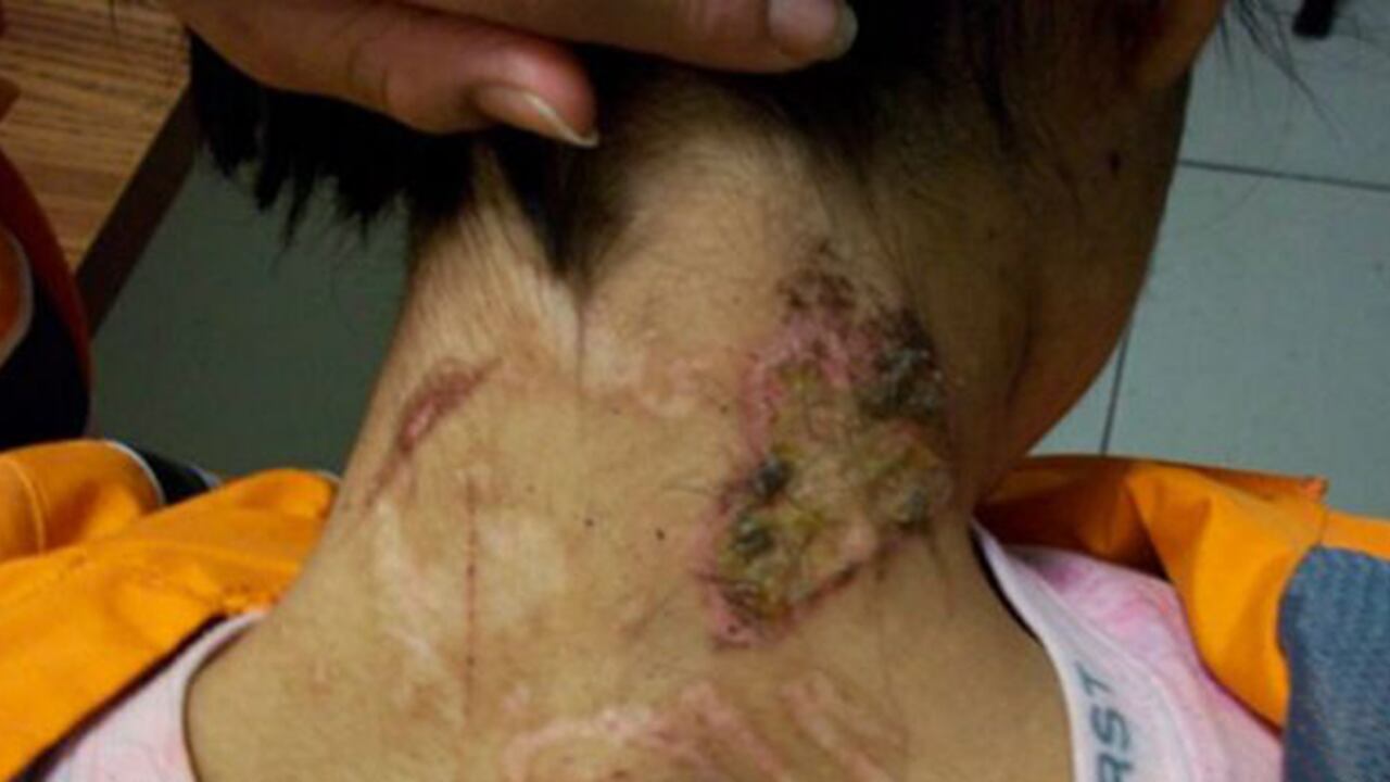 Zunduri cumplirá 23 años el próximo mes pero los exámenes médicos determinaron que sus órganos tienen el desgaste de una persona de 81 años.