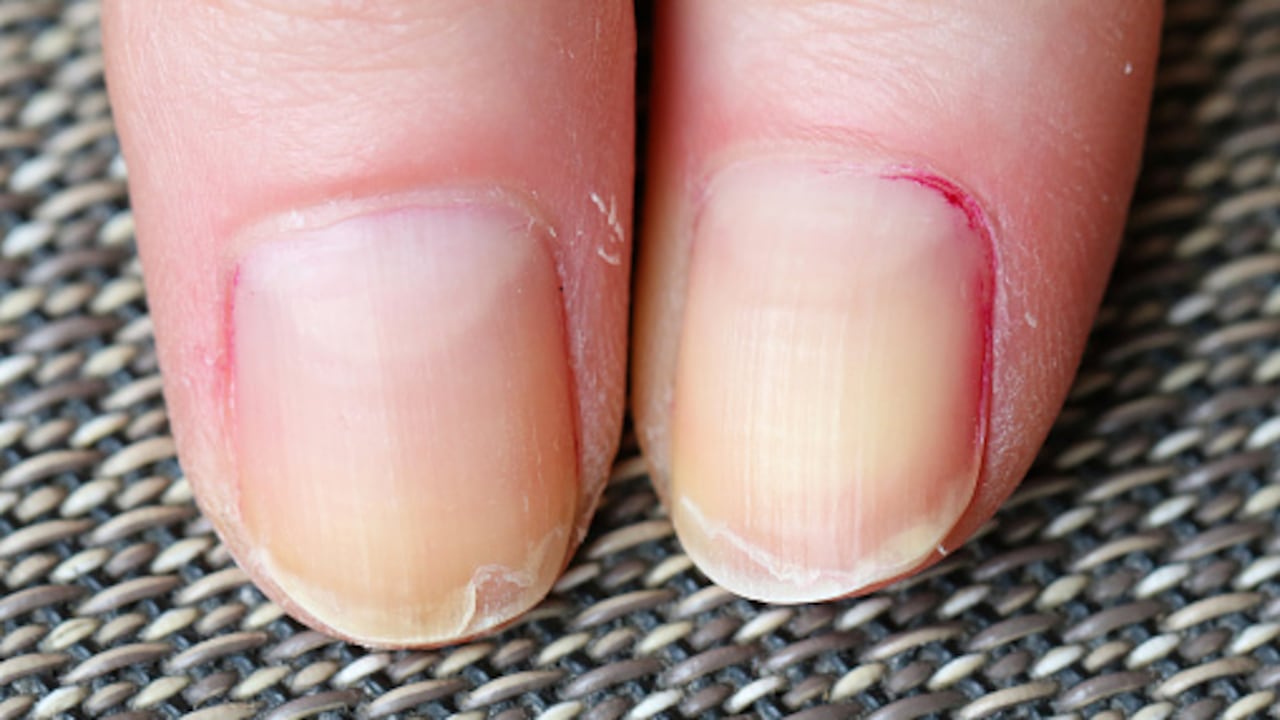 Los hongos en las uñas pueden provocar el color amarillo.