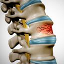 Si no se trata la osteoporosis a tiempo, puede que se quiebren los huesos.