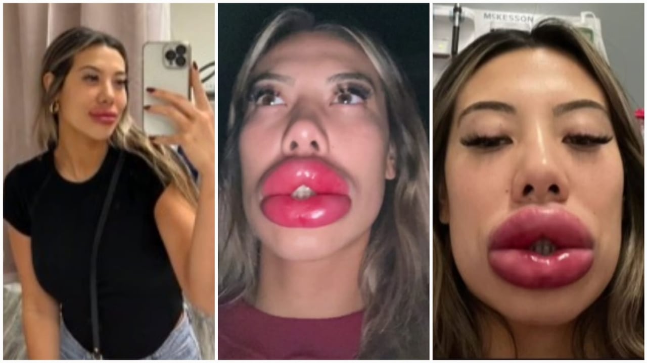 Labios Migrados Impactante: así se le hincharon los labios a una mujer por una reacción ...