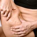 La celulitis puede traer problemas de autoestima.