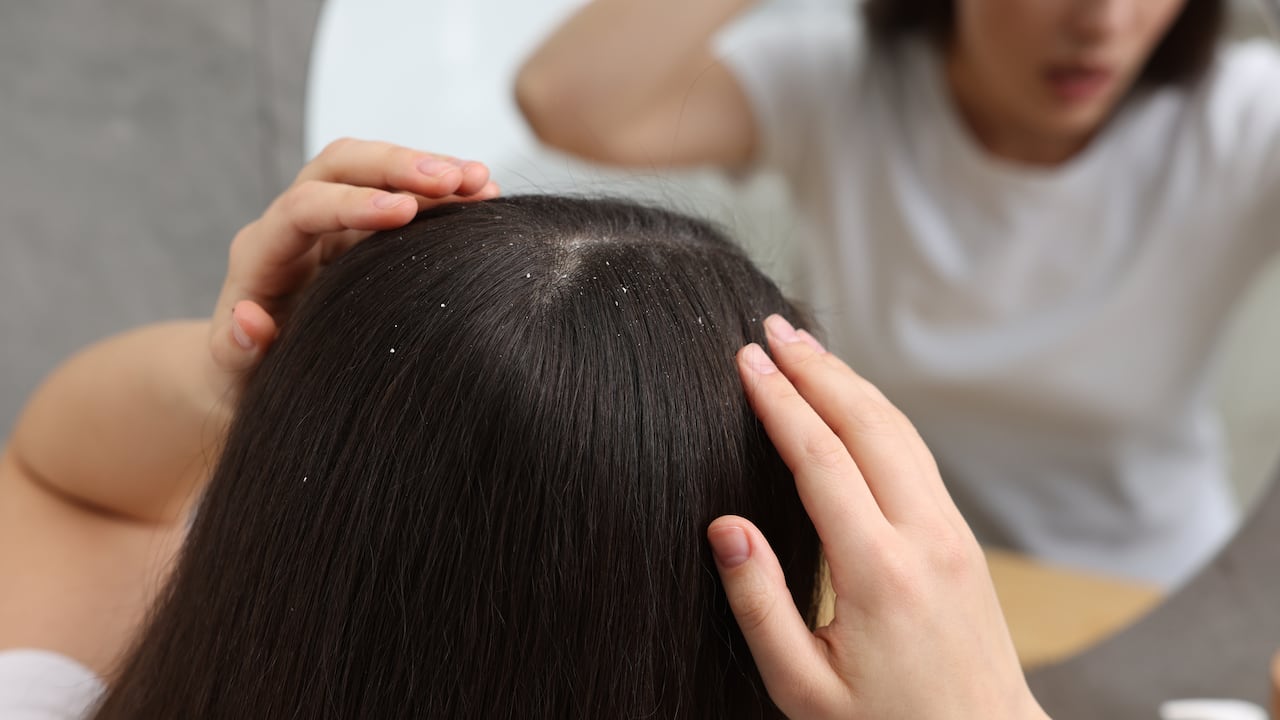 Descubra los beneficios ocultos de la canela y cómo puede ser la clave para un cuero cabelludo libre de caspa para sus lectores.