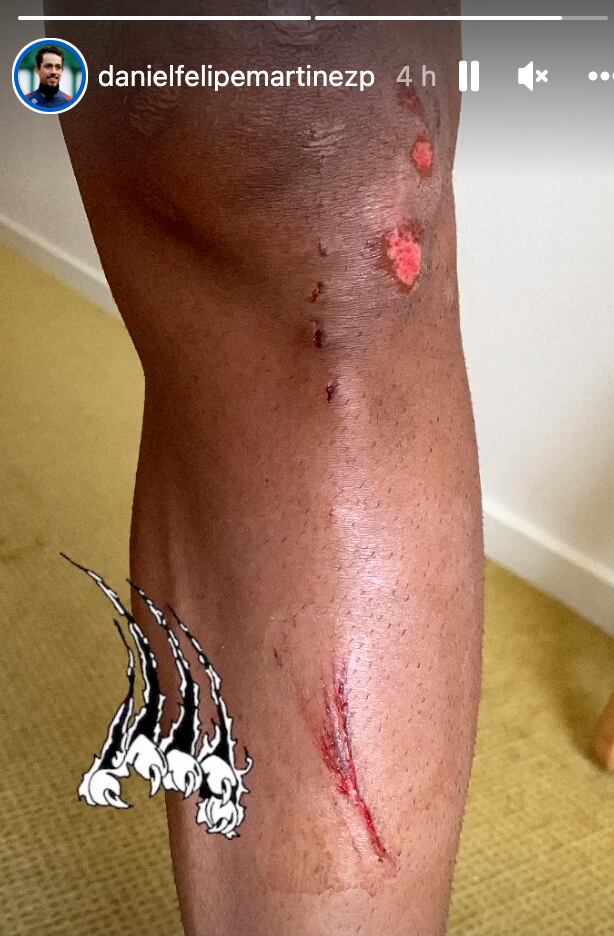 Tour de Francia 2022: Los golpes que dejaron en Daniel Felipe Martínez (INEOS), tras la caída masiva de la etapa 2