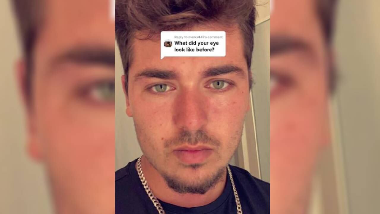 El joven tuvo que suspender sus actividades cotidianas y centrarse por completo en el tratamiento de su ojo.