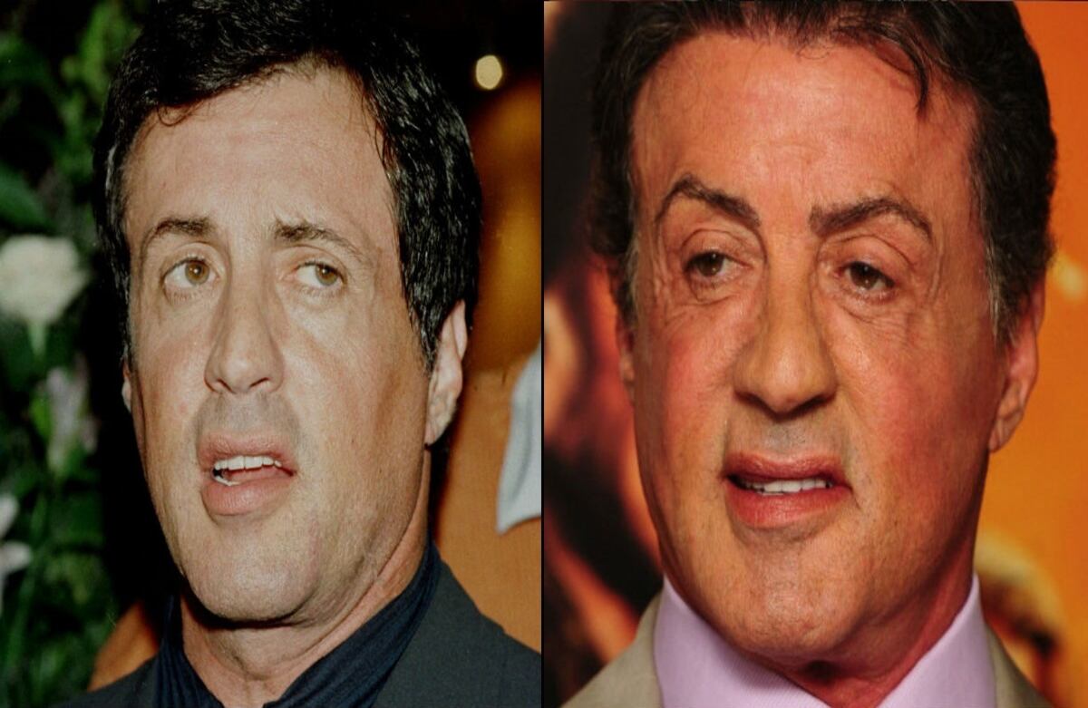 Se rumora que el actor Sylvester Stallone se hizo un estiramiento facial.