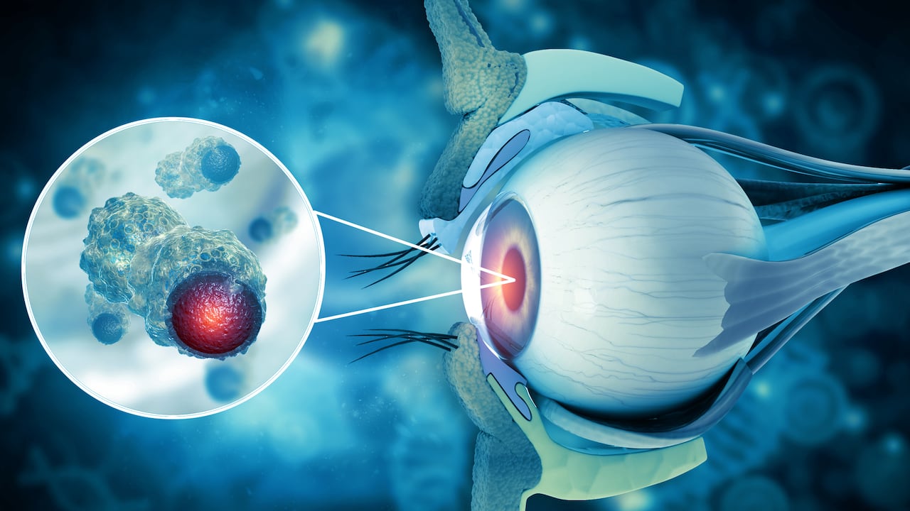 Hay muchos tipos diferentes de cánceres oculares, pero el tipo más común de cáncer ocular es el melanoma intraocular primario.