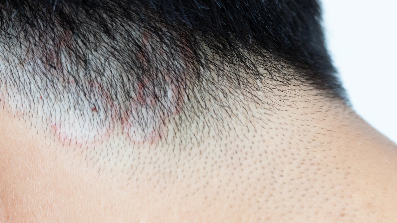 La tiña en la cabeza es una infección micótica contagiosa.