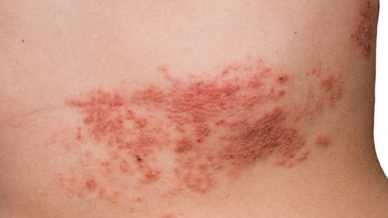 Los laboratorios tienen un nuevo proyecto común de vacuna de ARN mensajero (ARNm), contra el zóster varicela, conocido popularmente como 'culebrilla'.