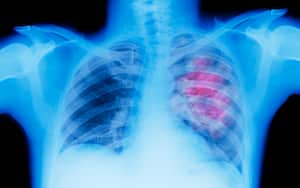 El cáncer de pulmón genera pérdida de peso y dolor en la espalda.