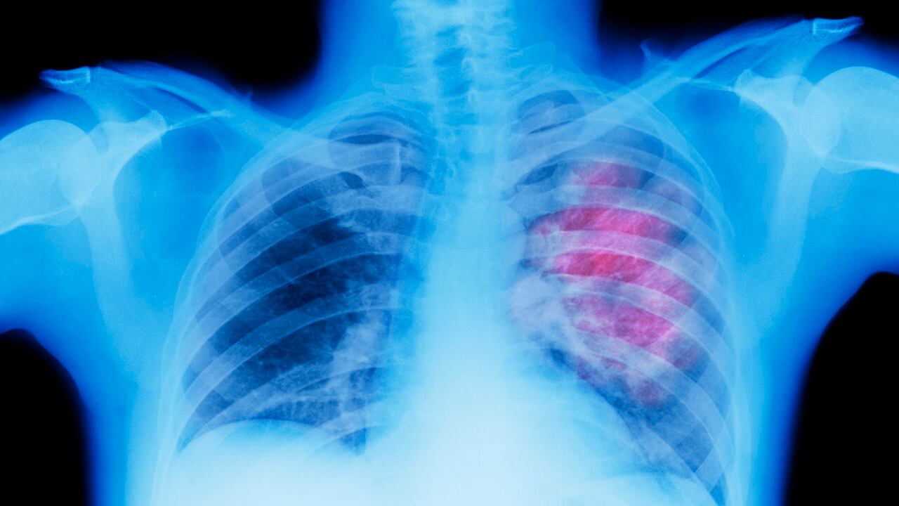 Cáncer de pulmón