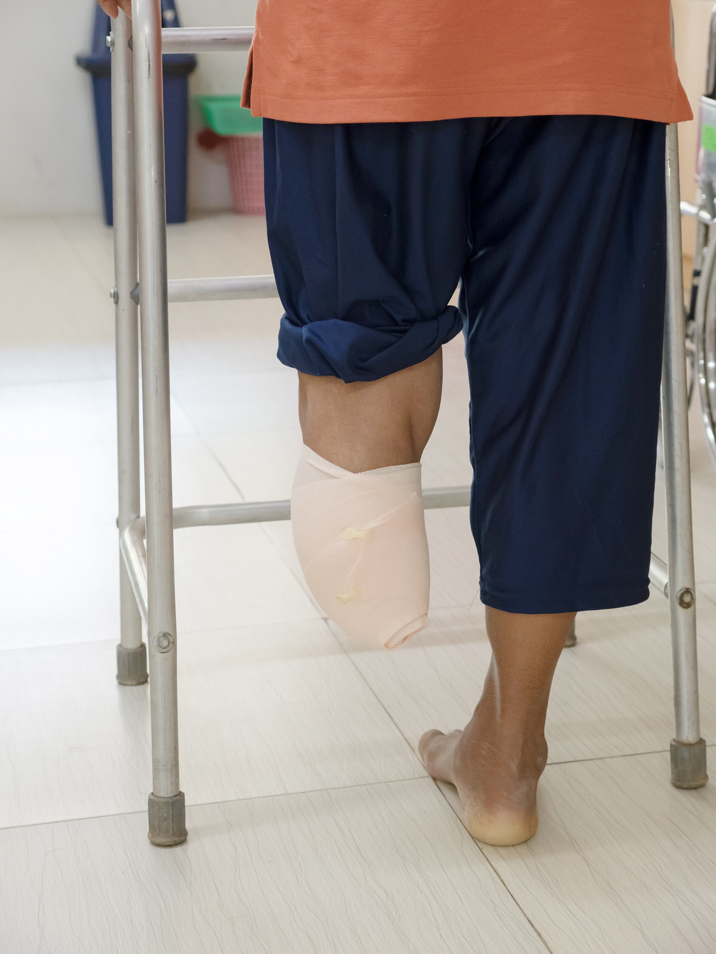 Amputación por pie diabético