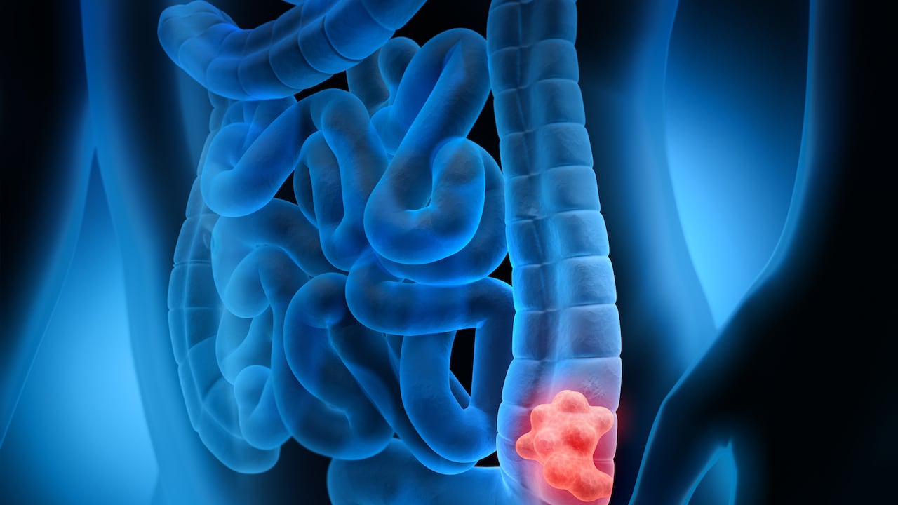 Foto de referencia sobre el cáncer de colon