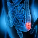 Foto de referencia sobre el cáncer de colon