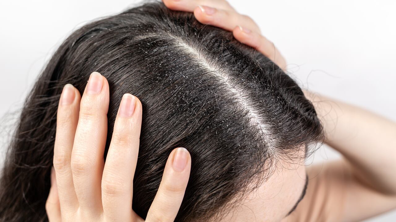 Existen varios remedios naturales que ayudan a mejorar el problema de caspa.