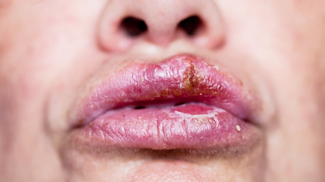 El cáncer de labio puede afectar en mayor medida a personas mayores de 40 años.