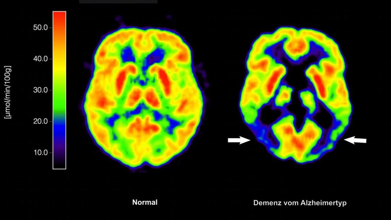 El exceso de grasas saturadas en la alimentación puede dañar el cerebro y aumentar la probabilidad de demencia.