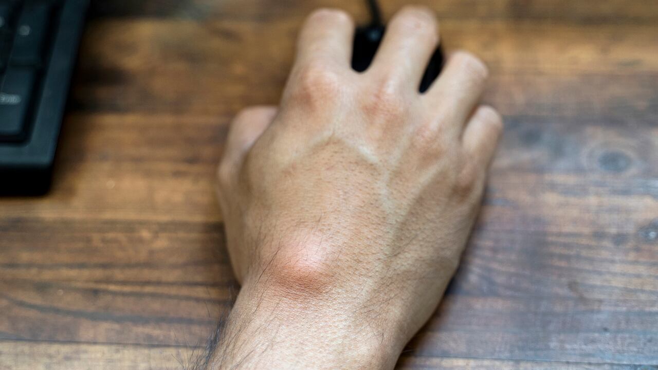 Ganglion cyst on man's hand. Hand holding computer mouse.