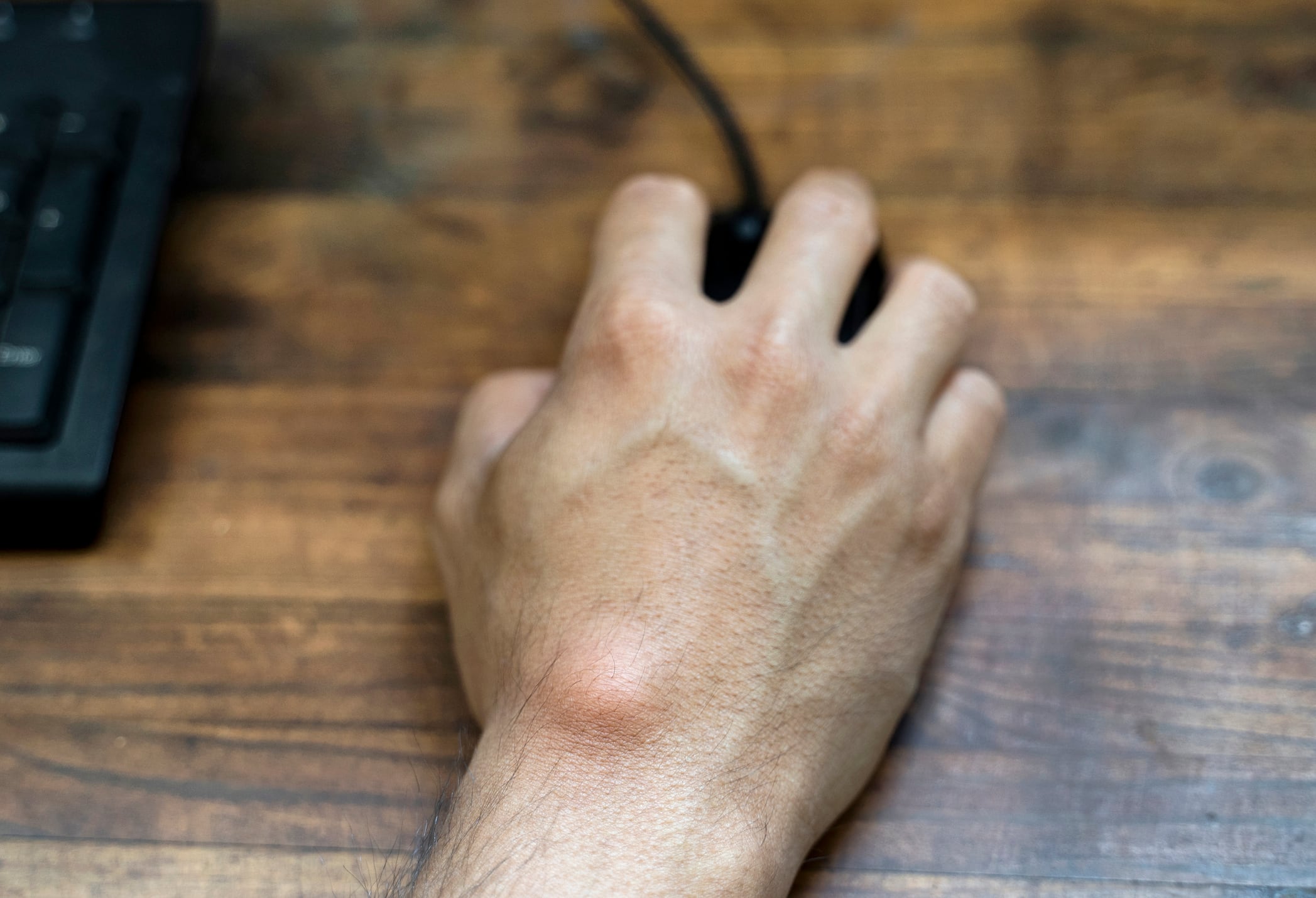 Ganglion cyst on man's hand. Hand holding computer mouse.