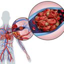 Los coágulos de sangre pueden formarse en el corazón y desplazarse a otras partes del cuerpo.