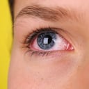 Los ojos rojos pueden presentarse por diversas razones, entre ellas, una infección.