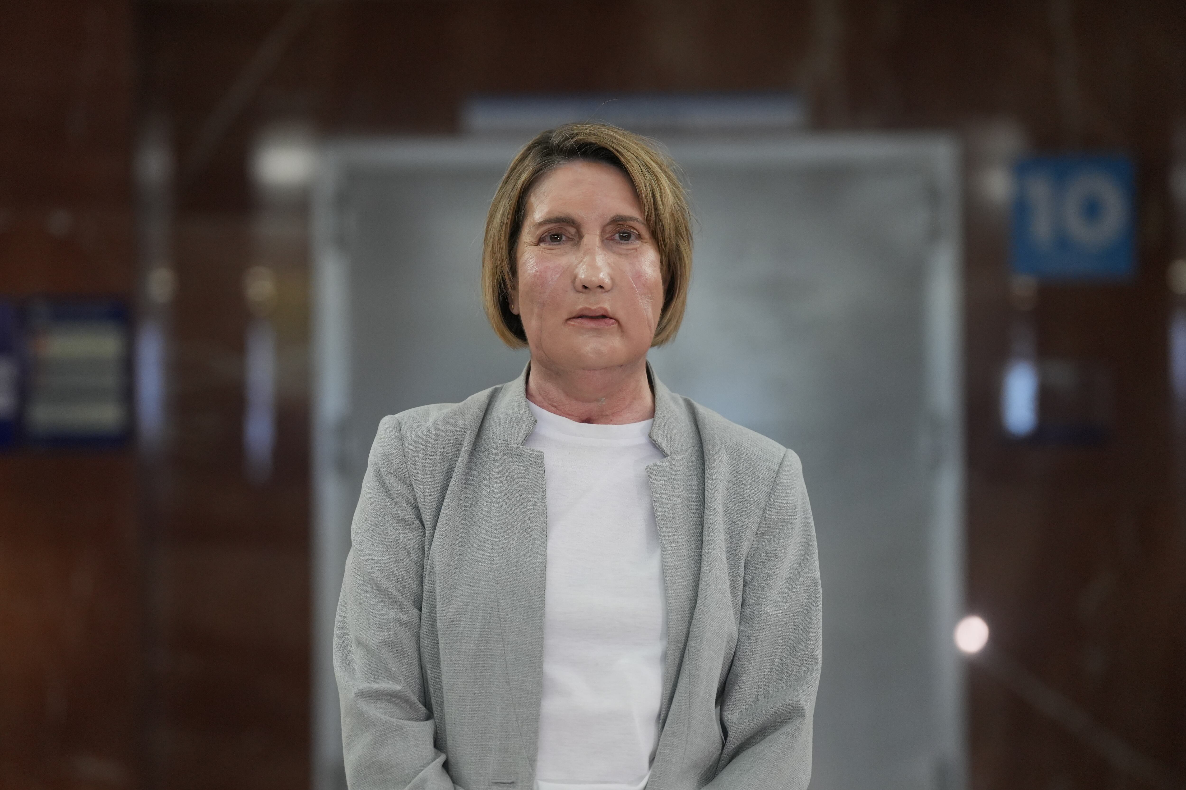 La paciente que recibió el trasplante en el Hospital Vall d'Hebron el 2 de febrero de 2026 en Barcelona, ​​Cataluña, España.