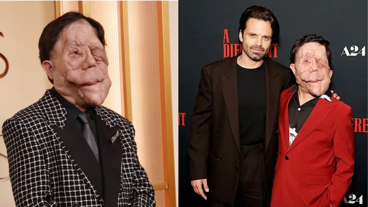 Adam Pearson padece neurofibromatosis tipo 1, una condición genética.