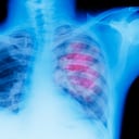 Existen varios tipos de cáncer que se pueden prevenir manteniendo buenos hábitos.