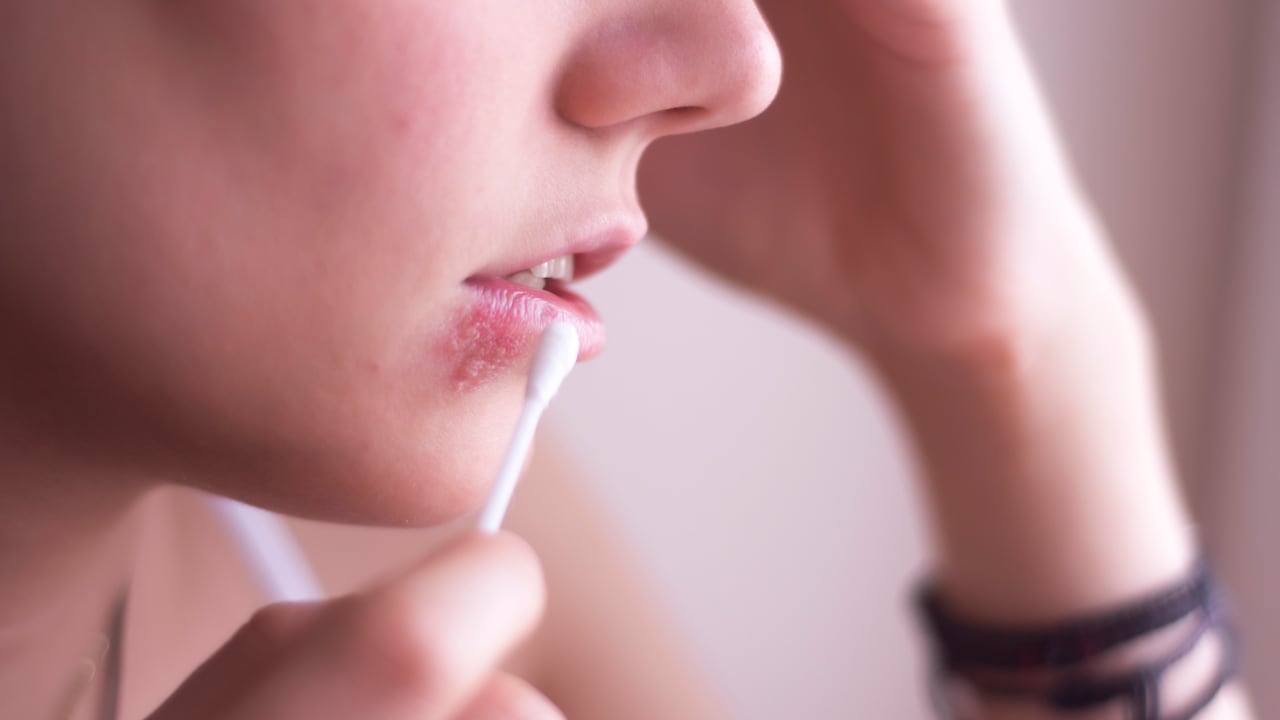 El herpes labial es una infección causada por un virus.