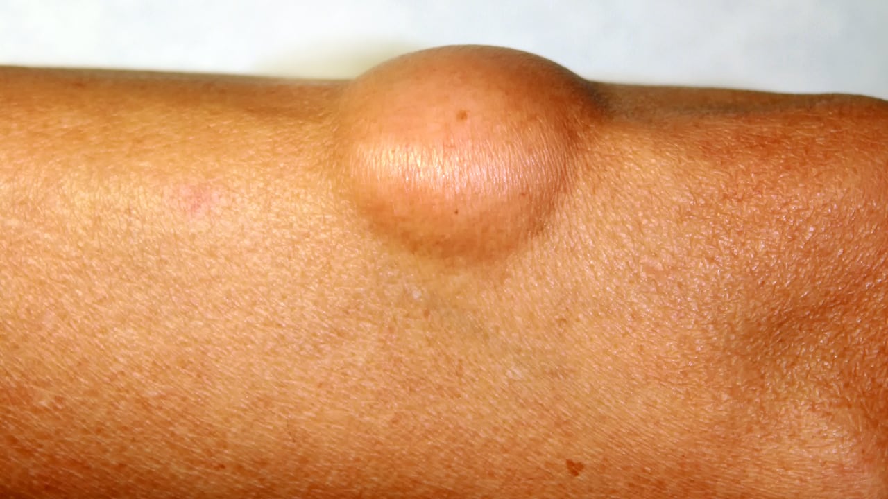 El brazo es uno de los lugares donde se detectan los lipomas.