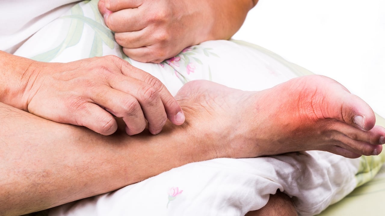 Inflamación en el dedo gordo del pie (gota)