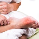 La gota se presenta principalmente en los hombres mayores.