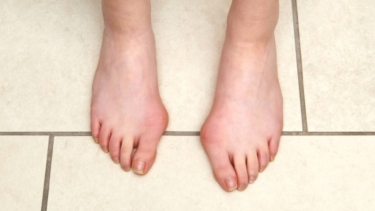 En algunos casos los juanetes causan mucho dolor. Foto: Getty Images.